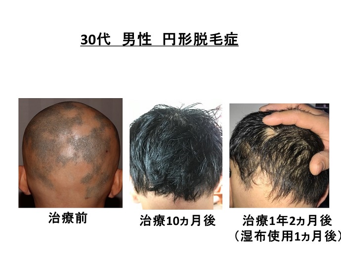 円形脱毛症　病院